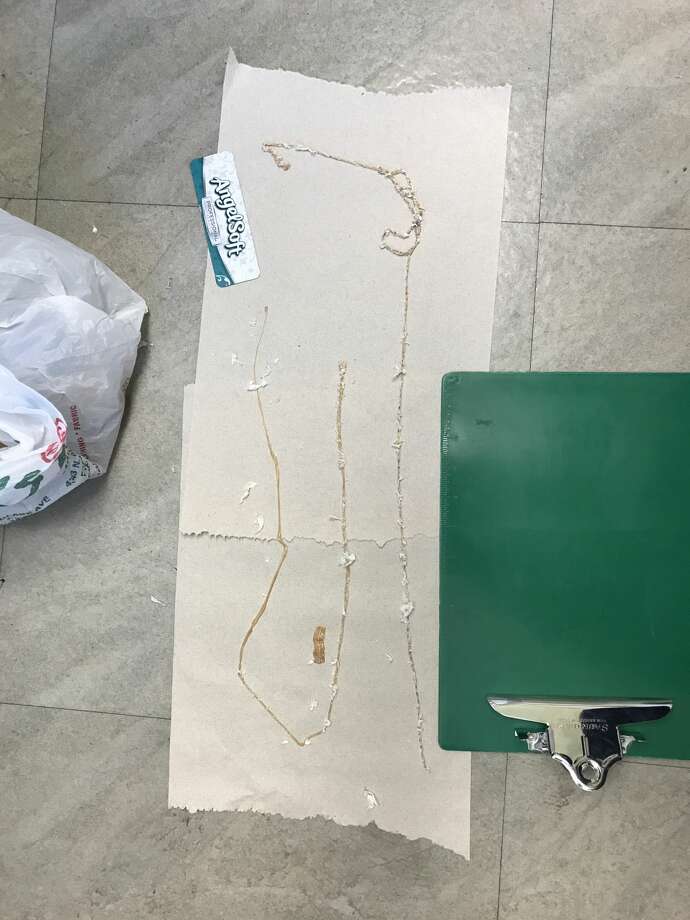 A Fresno man with a daily sushi habit had a 5 1/2-foot tapeworm lodged in his intestines, says a doctor at Fresno's Community Regional Medical Center. Photo: Courtesy Dr. Kenny Banh/This Won't Hurt A Bit Podcast